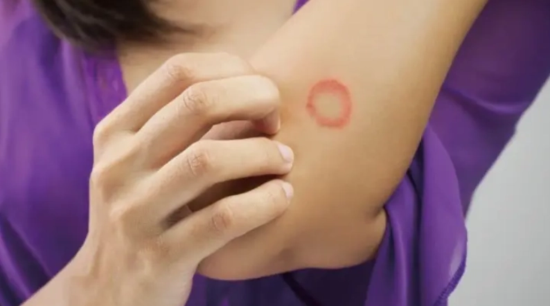 貓癬治療 貓癬治療