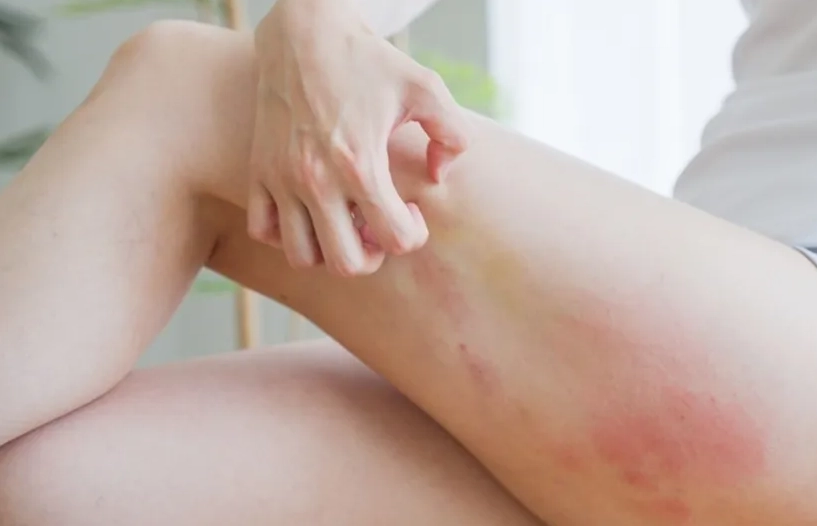 椰子油皮膚炎全攻略：症狀、治療與預防指南