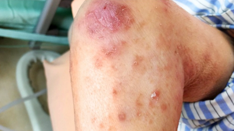 疥瘡症狀 疥瘡症狀