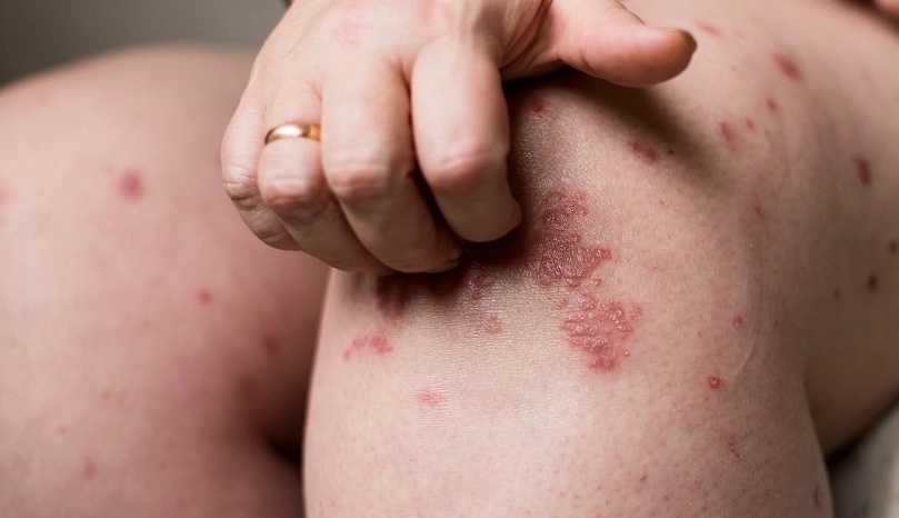 疥瘡治療 疥瘡治療