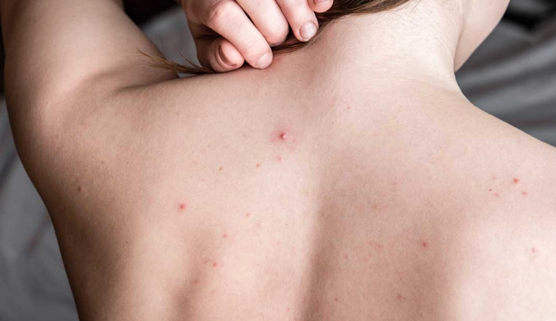 疥瘡症狀 疥瘡症狀