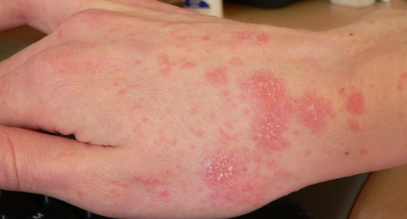 疥瘡症狀 疥瘡症狀