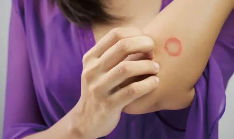 人感染貓癬用藥